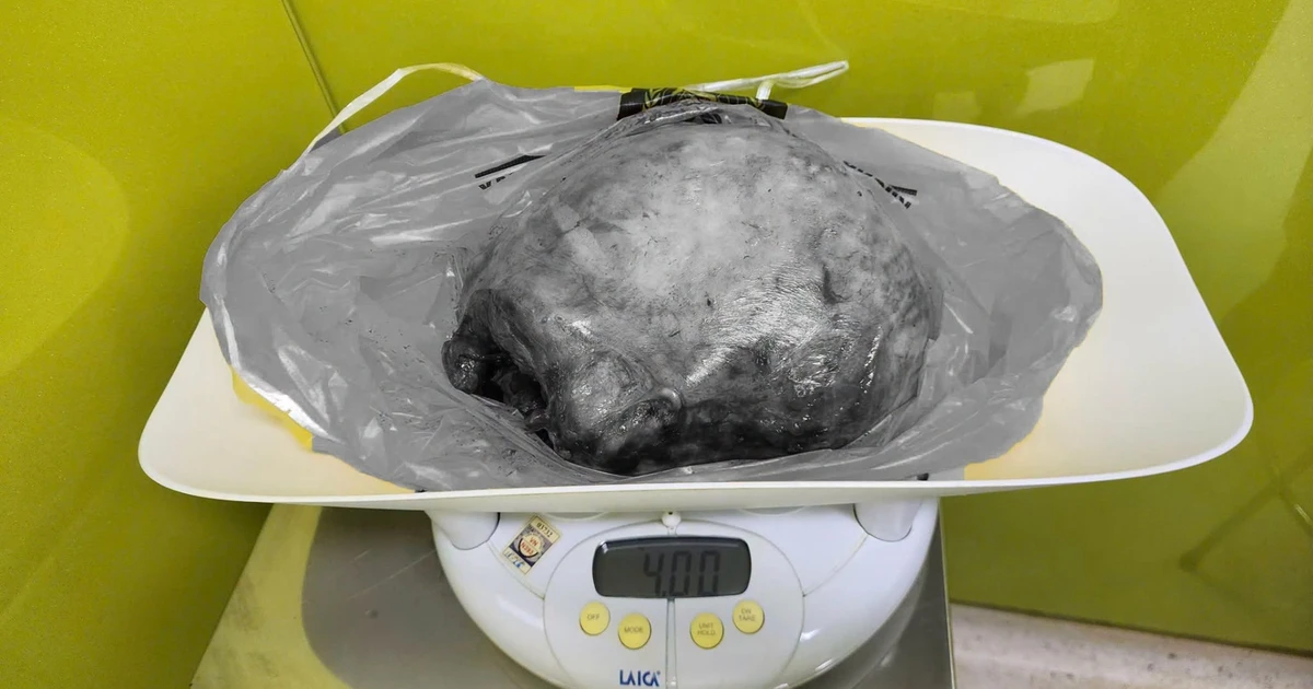 Bé trai chào đời an toàn dù mẹ mang khối u xơ tử cung 4kg